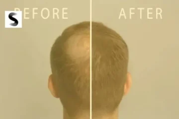 How To Prevent Possible Hair Loss In Men